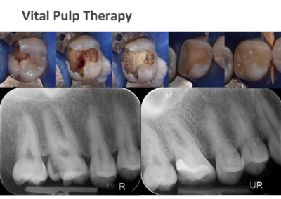 Vital Pulp Therapy