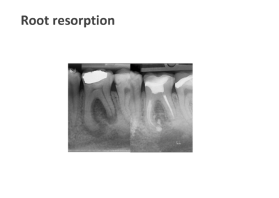 Root Resorption